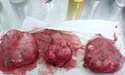 «Такі гігантські кісти ми бачили лише в університетських підручниках!»
