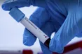 Коронавірус дістався до України: у МОЗ підтвердили інфікування Covid-19