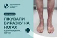 Вовчак маскувався під звичайну рану: львівські лікарі виявили небезпечну хворобу