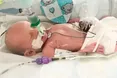 У Великій Британії лікарі повернули до життя немовля, яке народилося без ознак життя